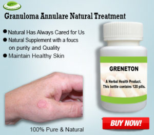 Top 7 Natural Remedies for Granuloma Annulare Treat Naturally – HerbalSupplements’s blog