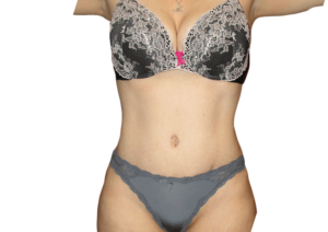 View the results and before and after photos of our Tummy Tuck procedures in our Houston, Texas  ...